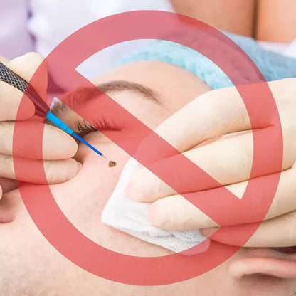 Remove excess marks within 7 days, no surgery, no discomfort, and no $500 clinic fee.