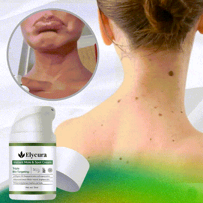 Remove excess marks within 7 days, no surgery, no discomfort, and no $500 clinic fee.